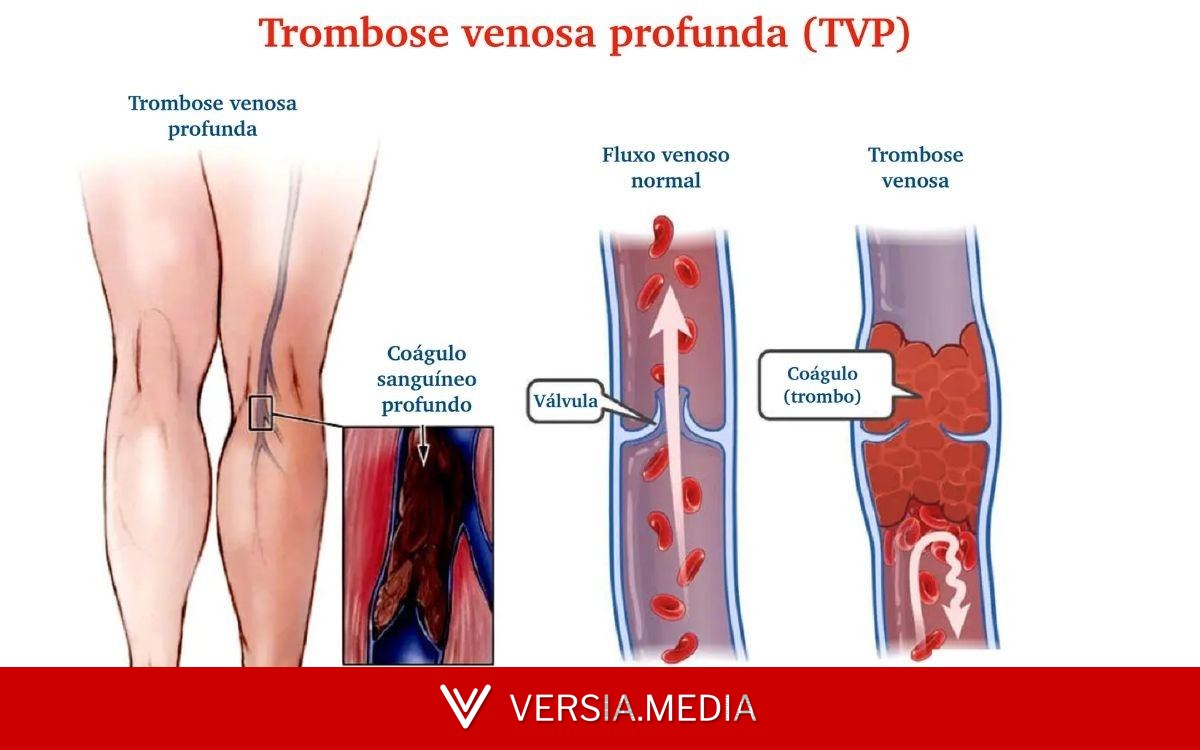 Trombose venosa: a complicação mais temida das varizes