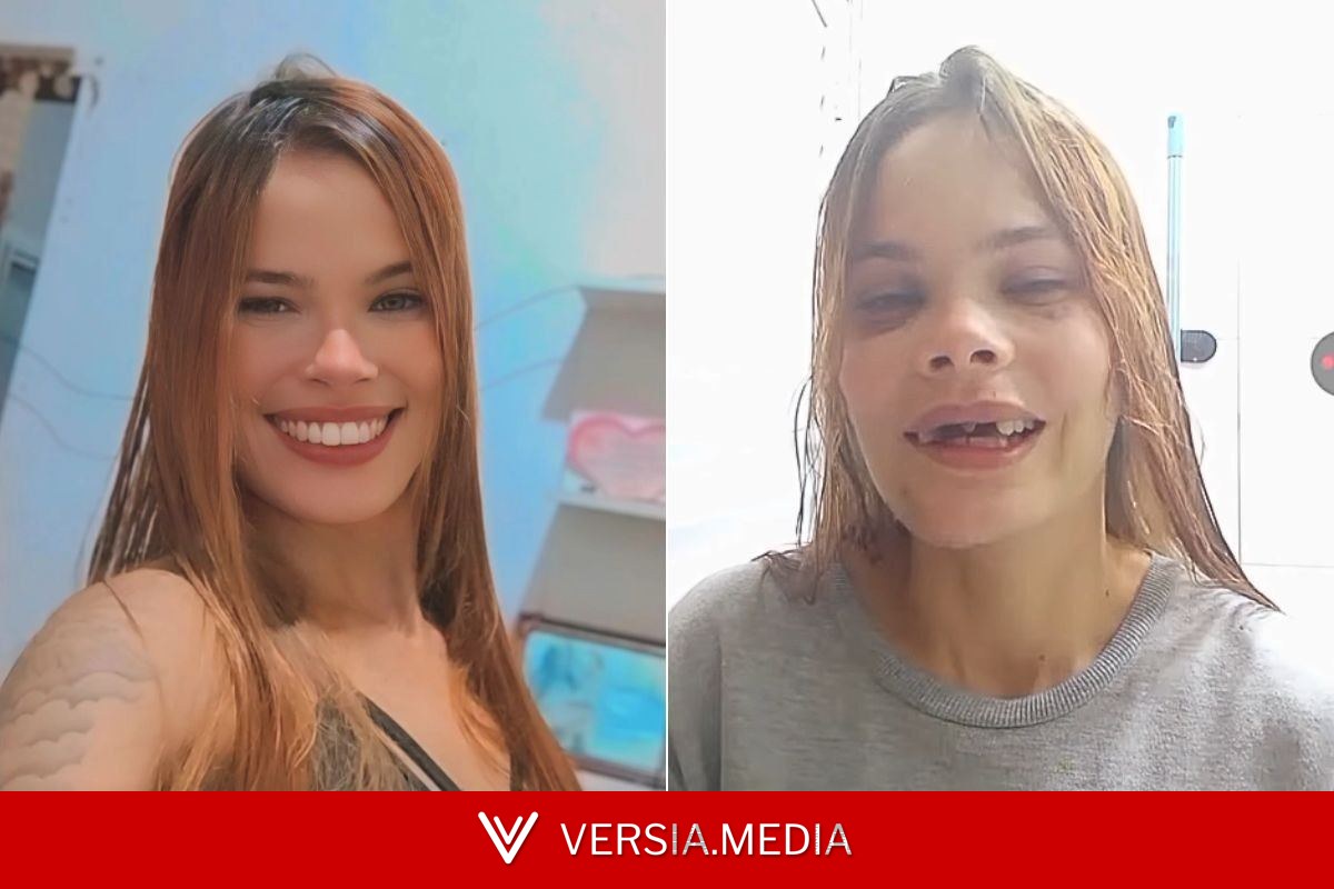 Jovem perde cinco dentes em acidente de moto e sonha com prótese: 'Foi como perder a minha identidade'